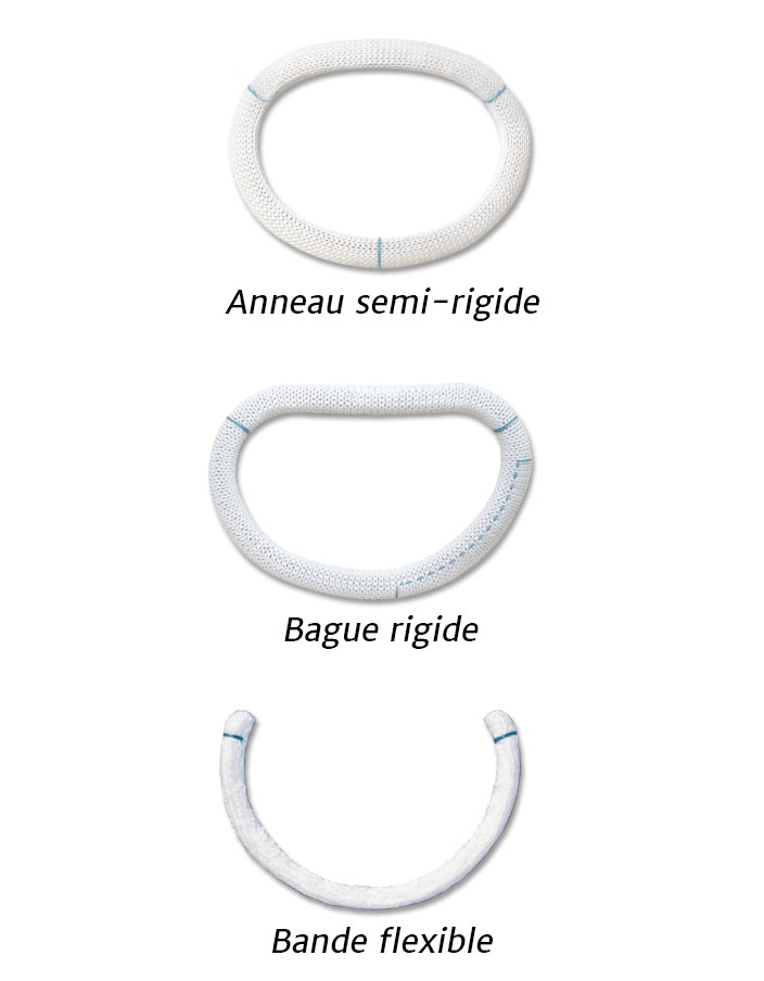 valve rings