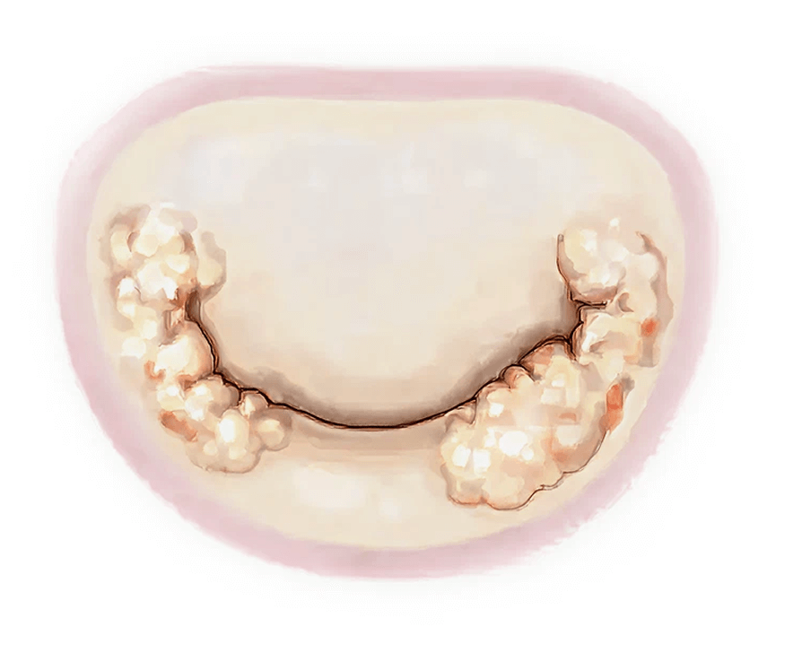 What is the Mitral Stenosis