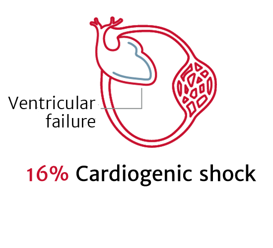 Cardiogenic shock