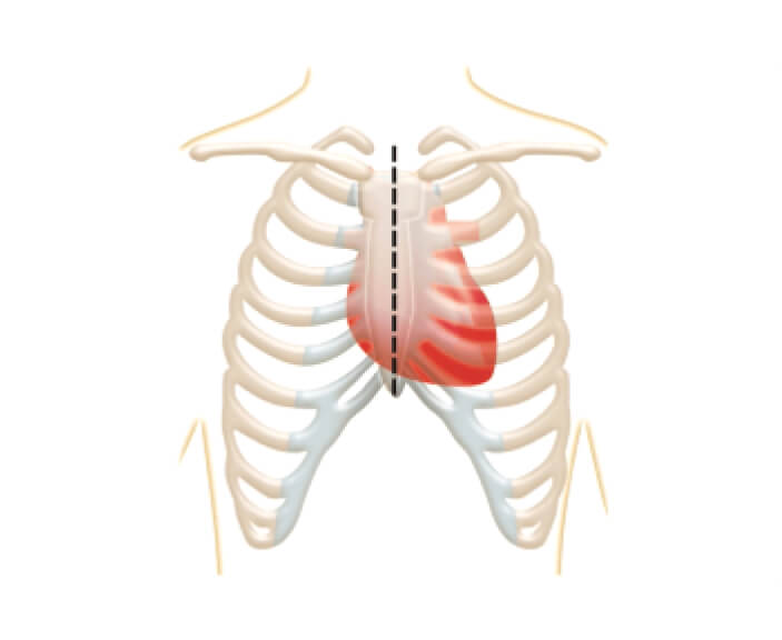 Open-heart surgery where the surgeon makes a cut through the breastbone to reach the heart.