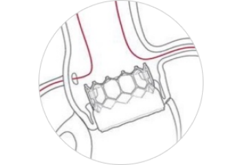 calculated stent structure