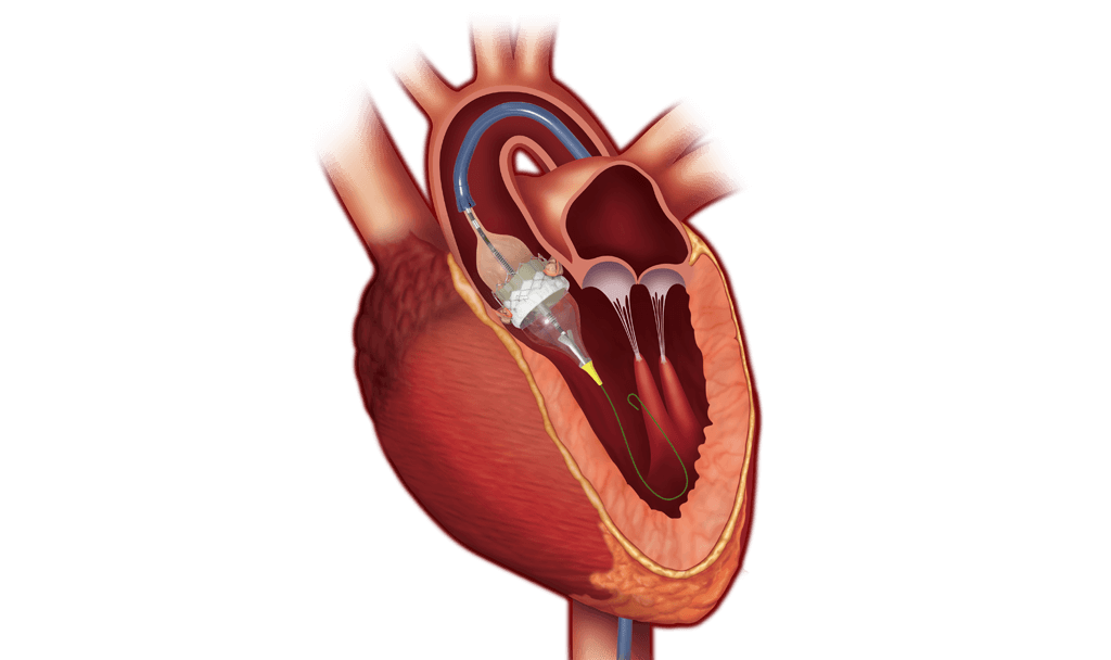 SAPIEN 3 valve - Anatomic illustration deployed