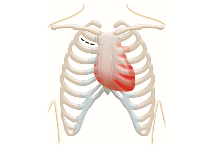 Thoracotomy