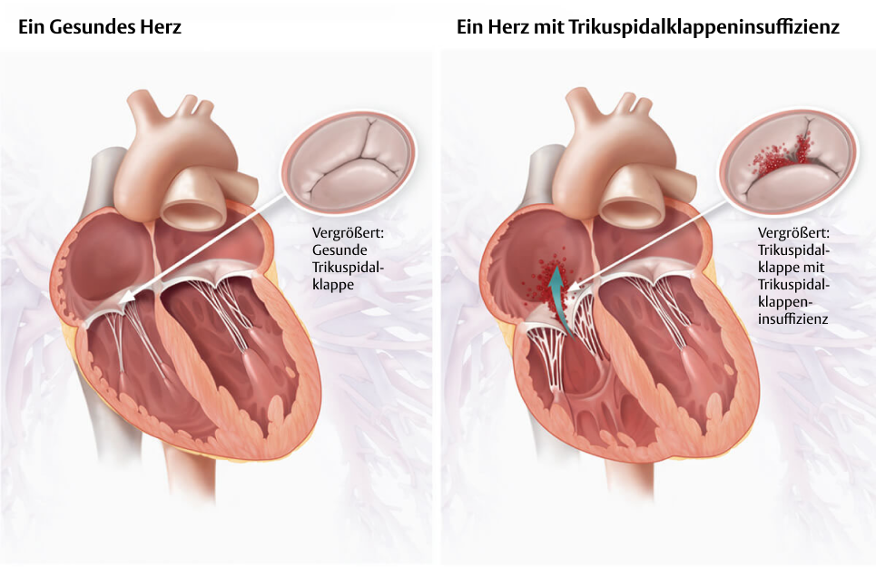 Healthy heart vs heart with tricuspid regurgitation