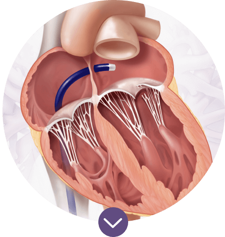 Transseptal access