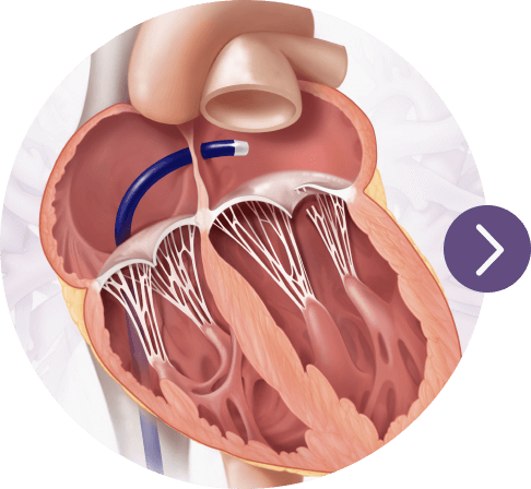 Transseptal access