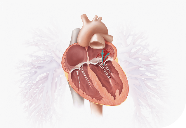 Degenerative MR (DMR) 1
