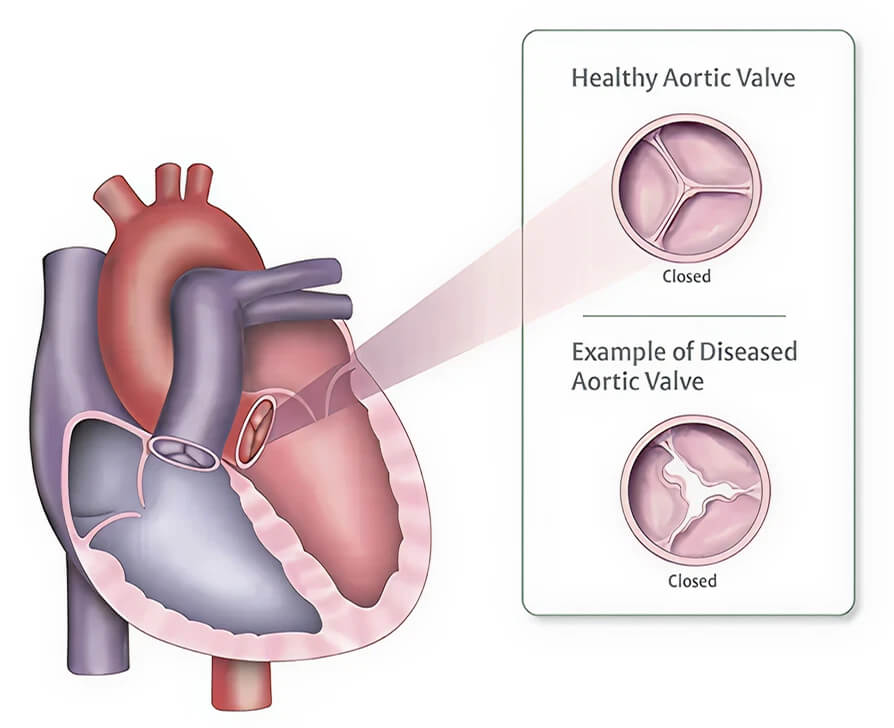 What is Aortic Regurgitation