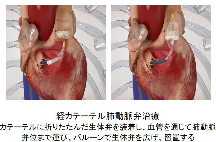 Japan's First Transcatheter Pulmonary Valve Treatment 1
