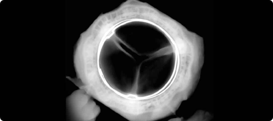 RESILIA tissue valve