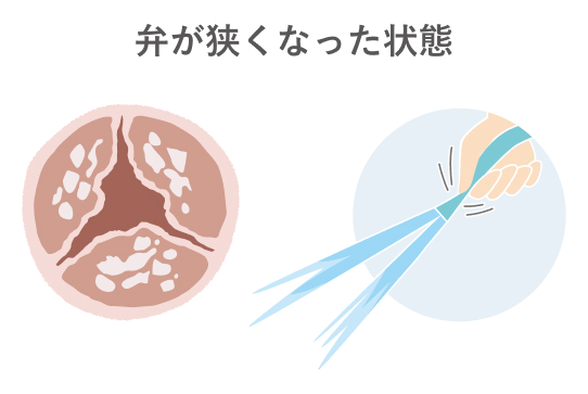 What is aortic stenosis 2