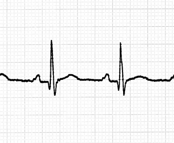 electrocardiogram test