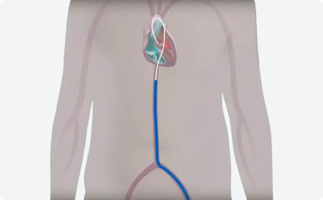 Step 3 TAVI Procedure