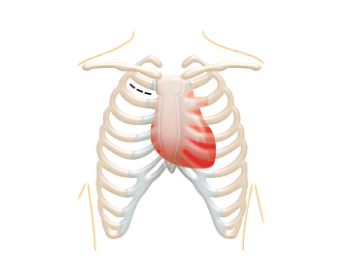 thoracotomy