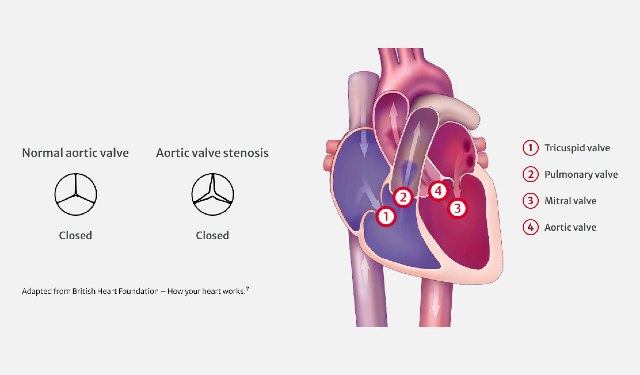 normal aortic valve vs aortic valve stenosis