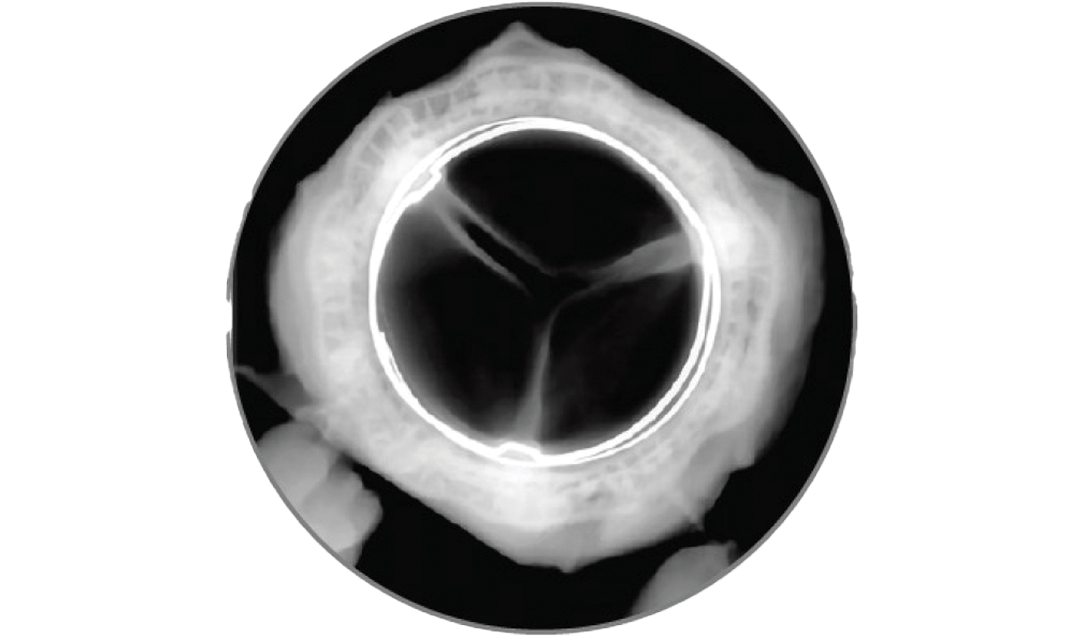 RESILIA tissue valve