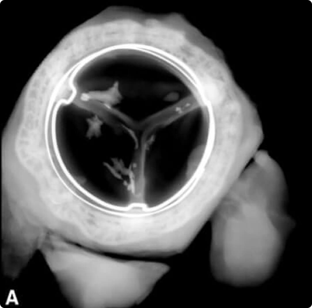 A = PERIMOUNT Tissue Valve
