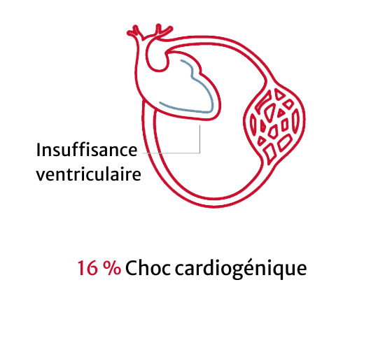 Cardiogenic shock