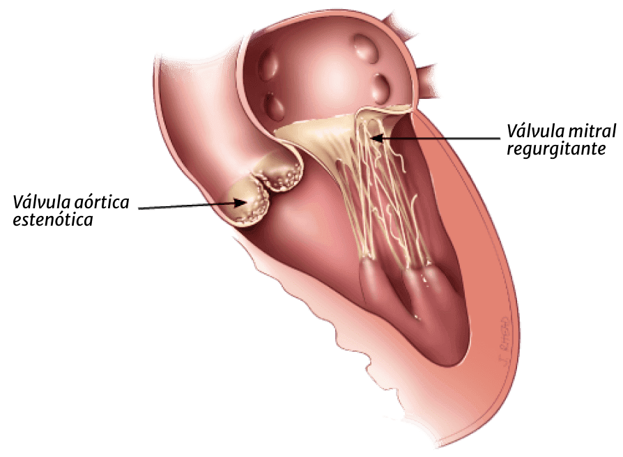 heart valve side