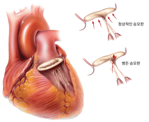 Degenerative valve disease