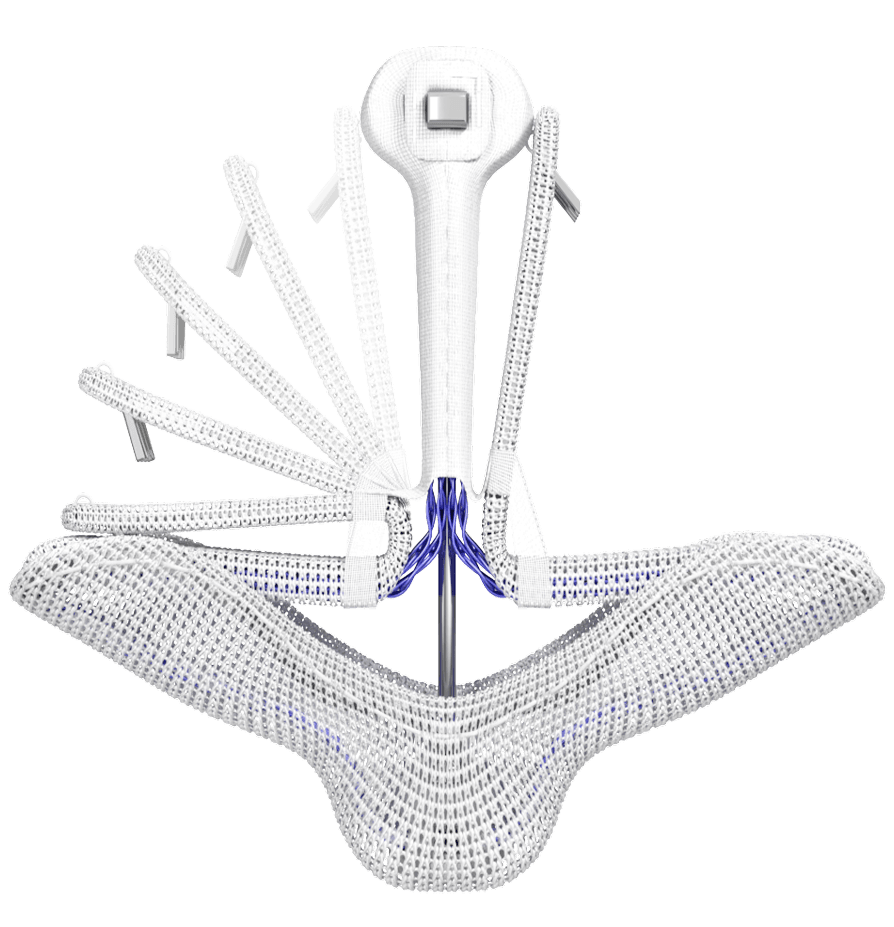 PASCAL Precision implant with its paddles shown fanning open through a range of positions