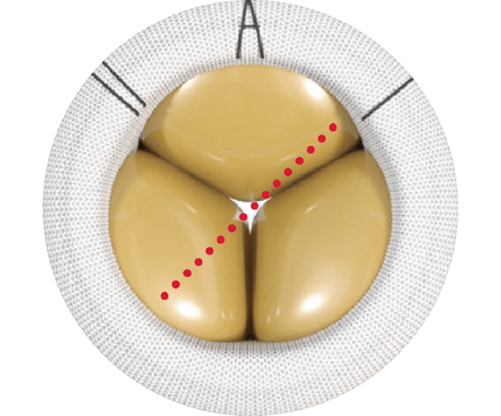 Mitral Valve 2