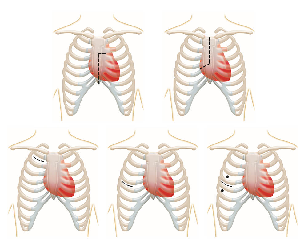 thoracotomy