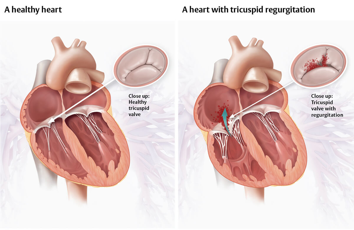 Healthy heart vs heart with tricuspid regurgitation