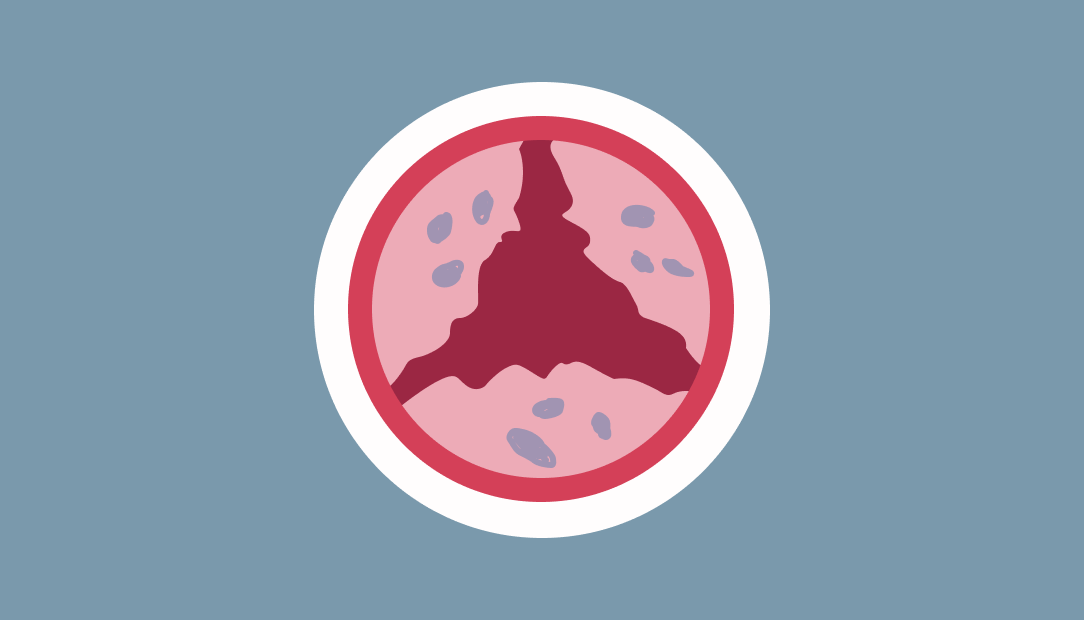 moderate aortic stenosis