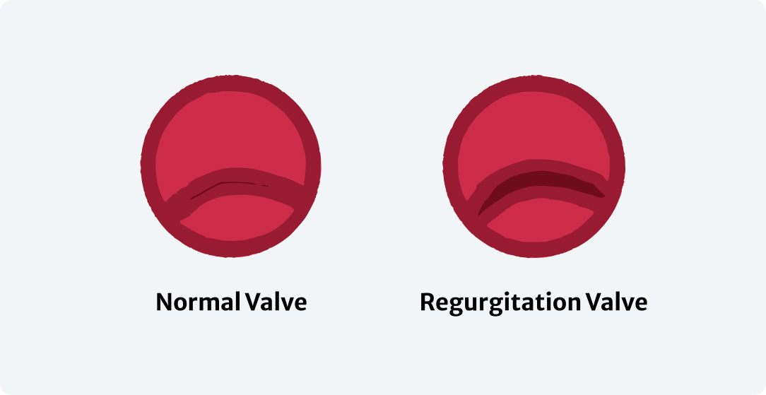 Mitral Regurgitation - Image