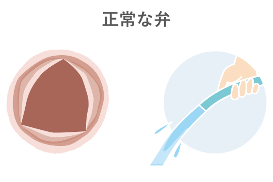 What is aortic stenosis 1