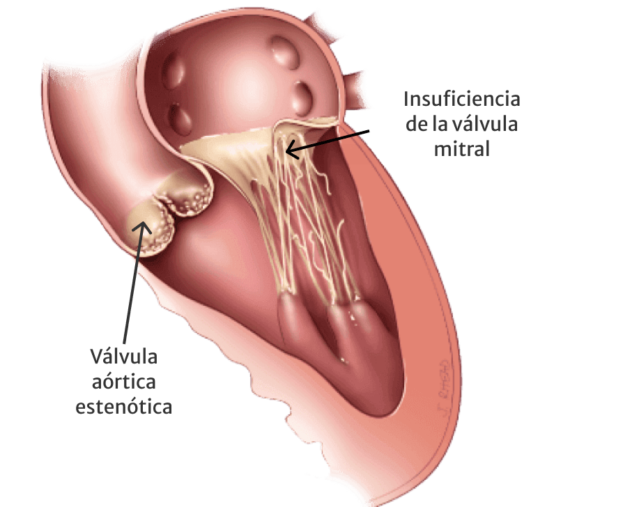 heart valve side