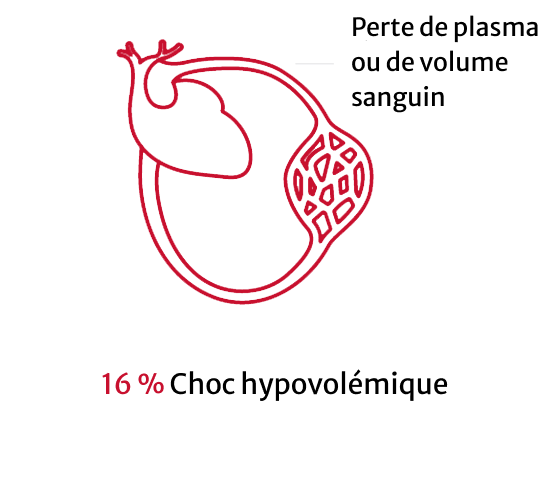 Hypovolemic shock