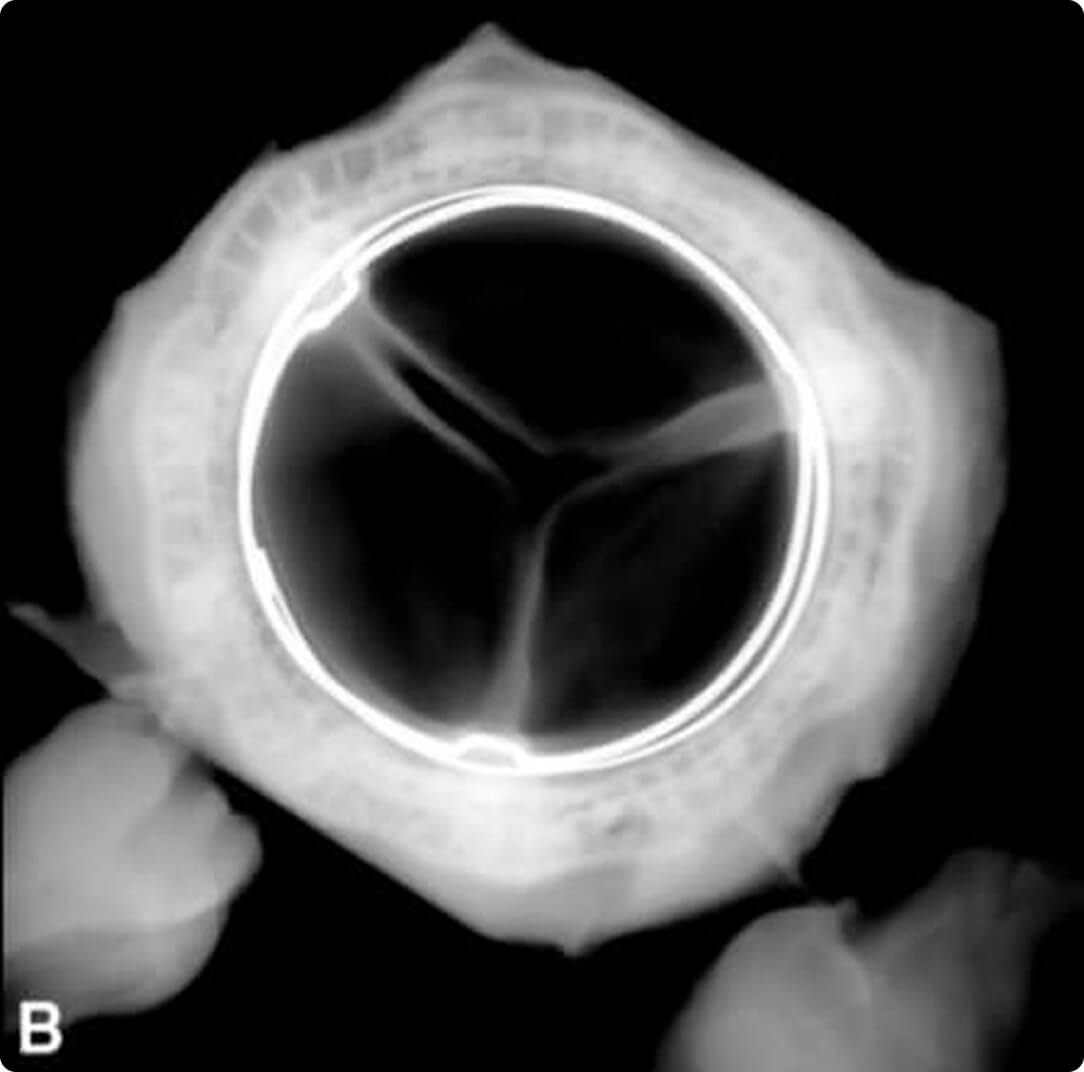 B = RESILIA Tissue Valve