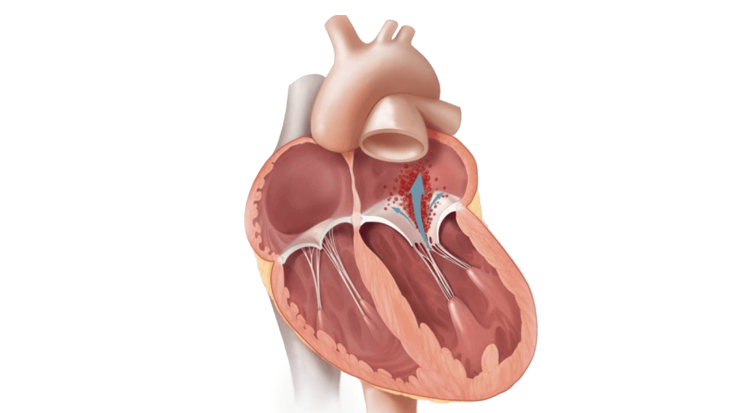 Mitral regurgitation