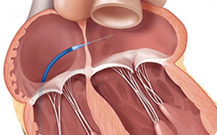 TEER procedure step 2