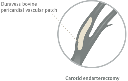 carotid endarterectomy