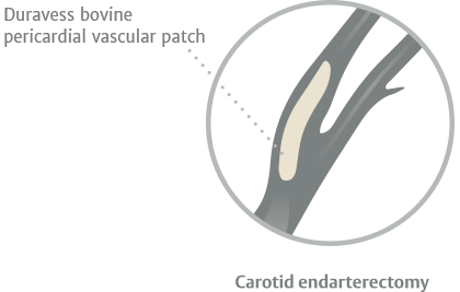 carotid endarterectomy