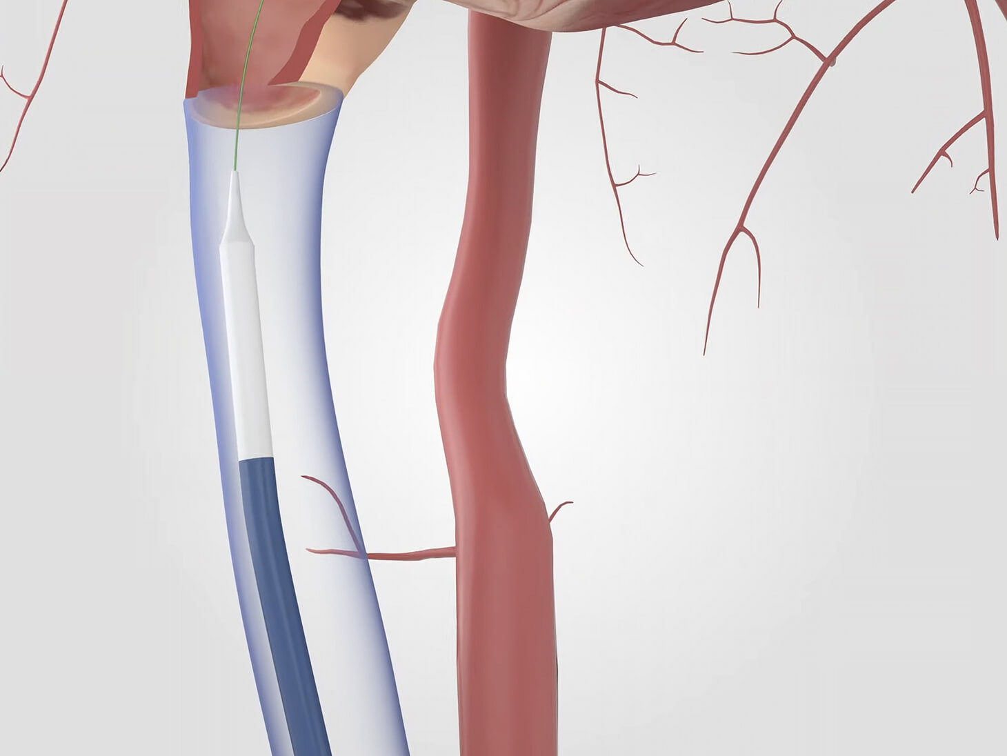 The implant is positioned in the delivery catheter