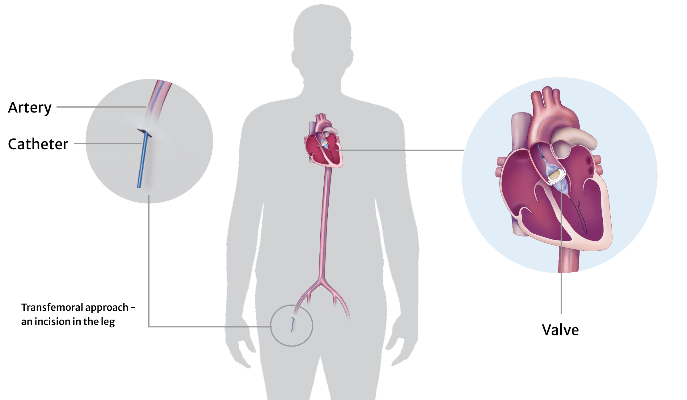 Infographic patient AViV