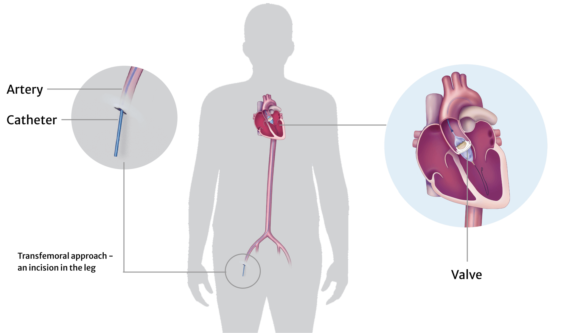 Infographic patient AViV