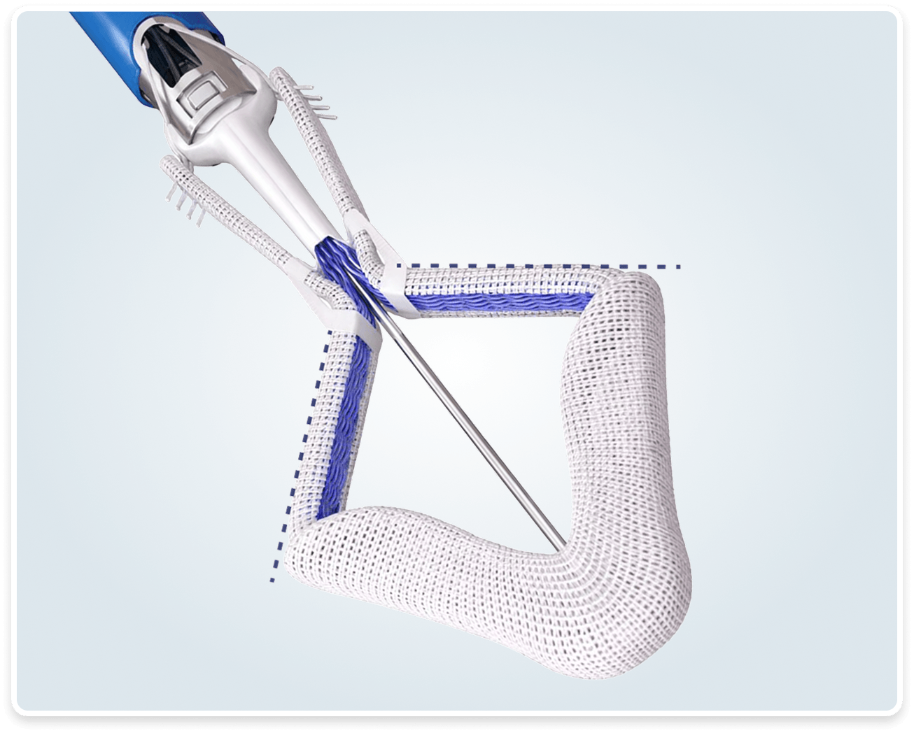 PASCAL Precision implant clasp opening toward the inner paddle