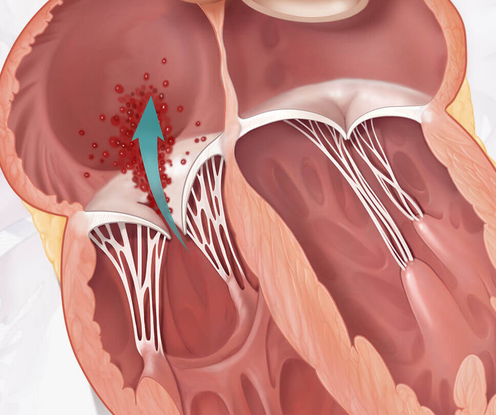 Tricuspid regurgitation