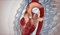Transcatheter SAPIEN 3 TAVR gallery item 3
