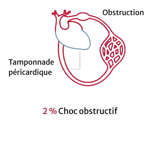 Obstructive shock