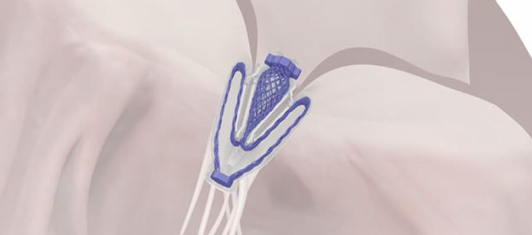 Nitinol Construction
