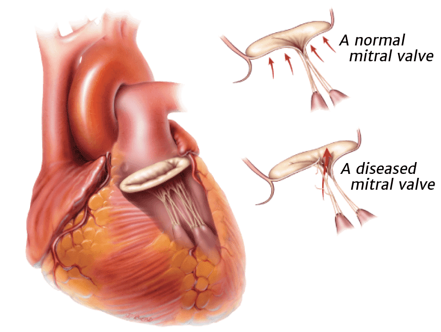 Degenerative valve disease
