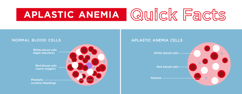 Aplastic Anemia Ilustration DKMS
