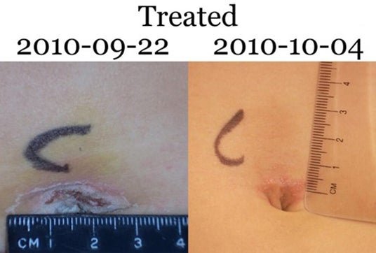 Treated wound C with ruler