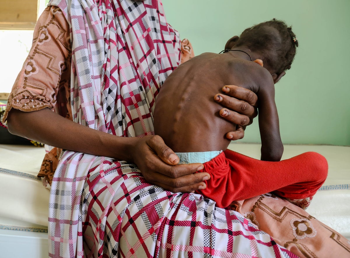 Child with acute malnutrition